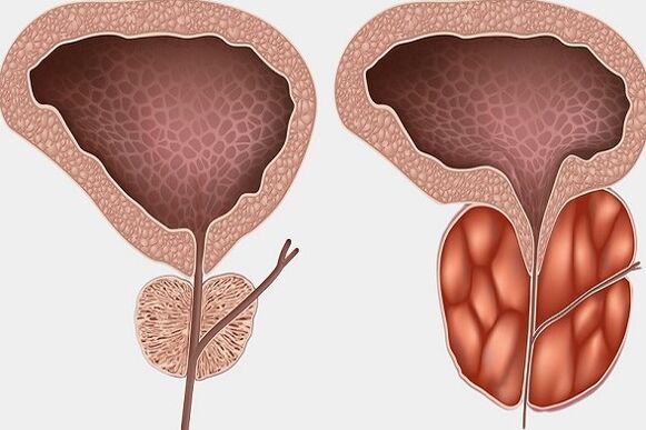 Inflamarea prostatei