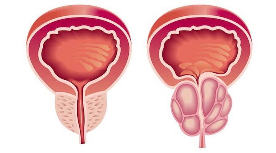 Prostată sănătoasă și inflamată cu prostatită