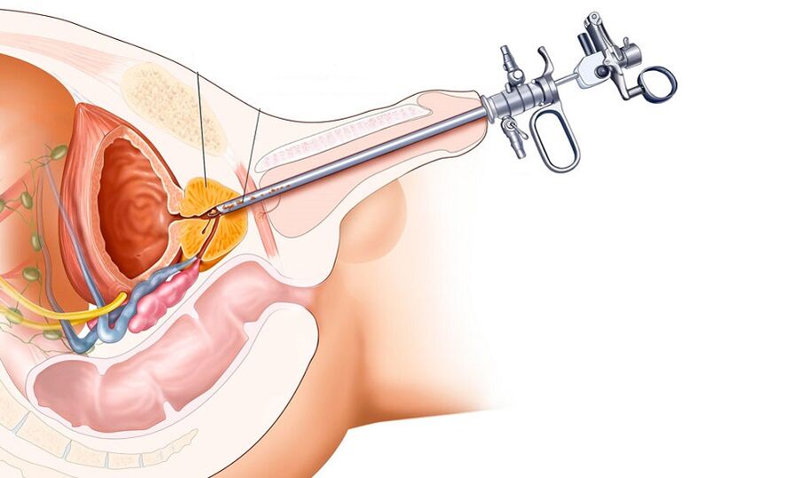 Tratamentul chirurgical al prostatitei